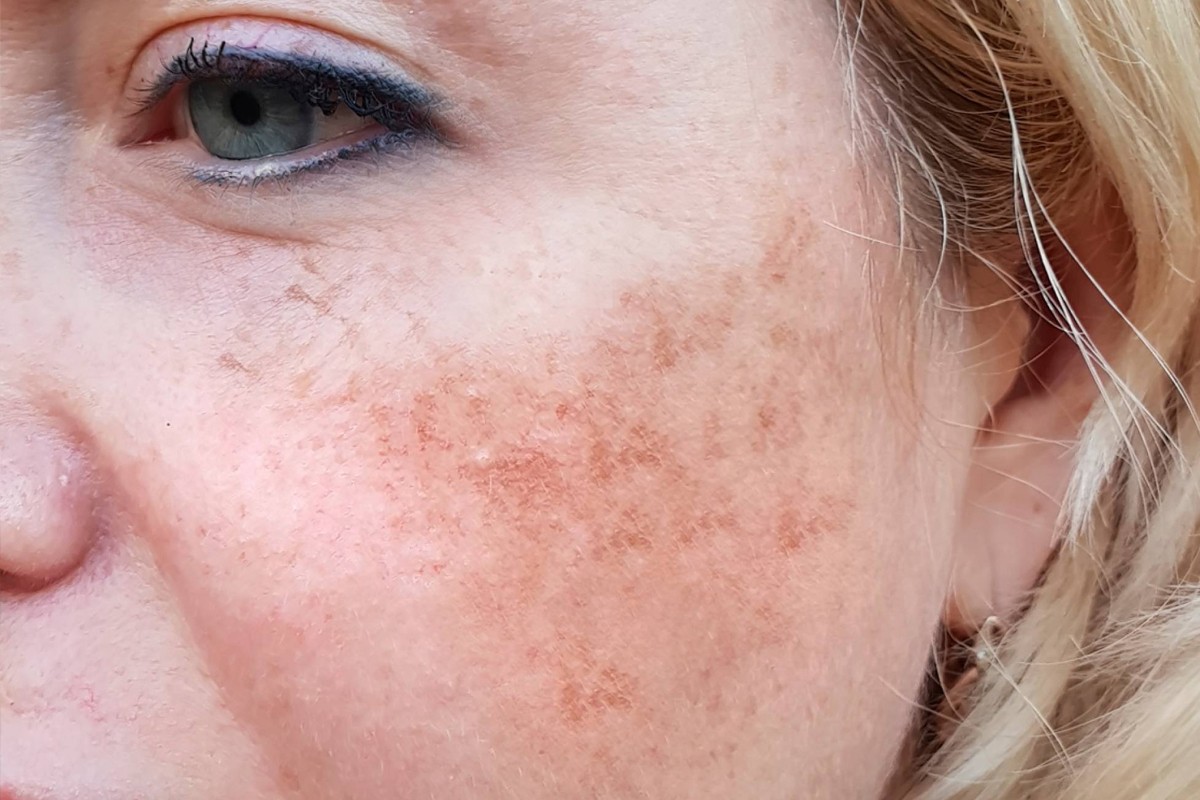 Azelaic Acid for Skin: The Gentle Brightening Ingredient Women Over 40 Are Switching To