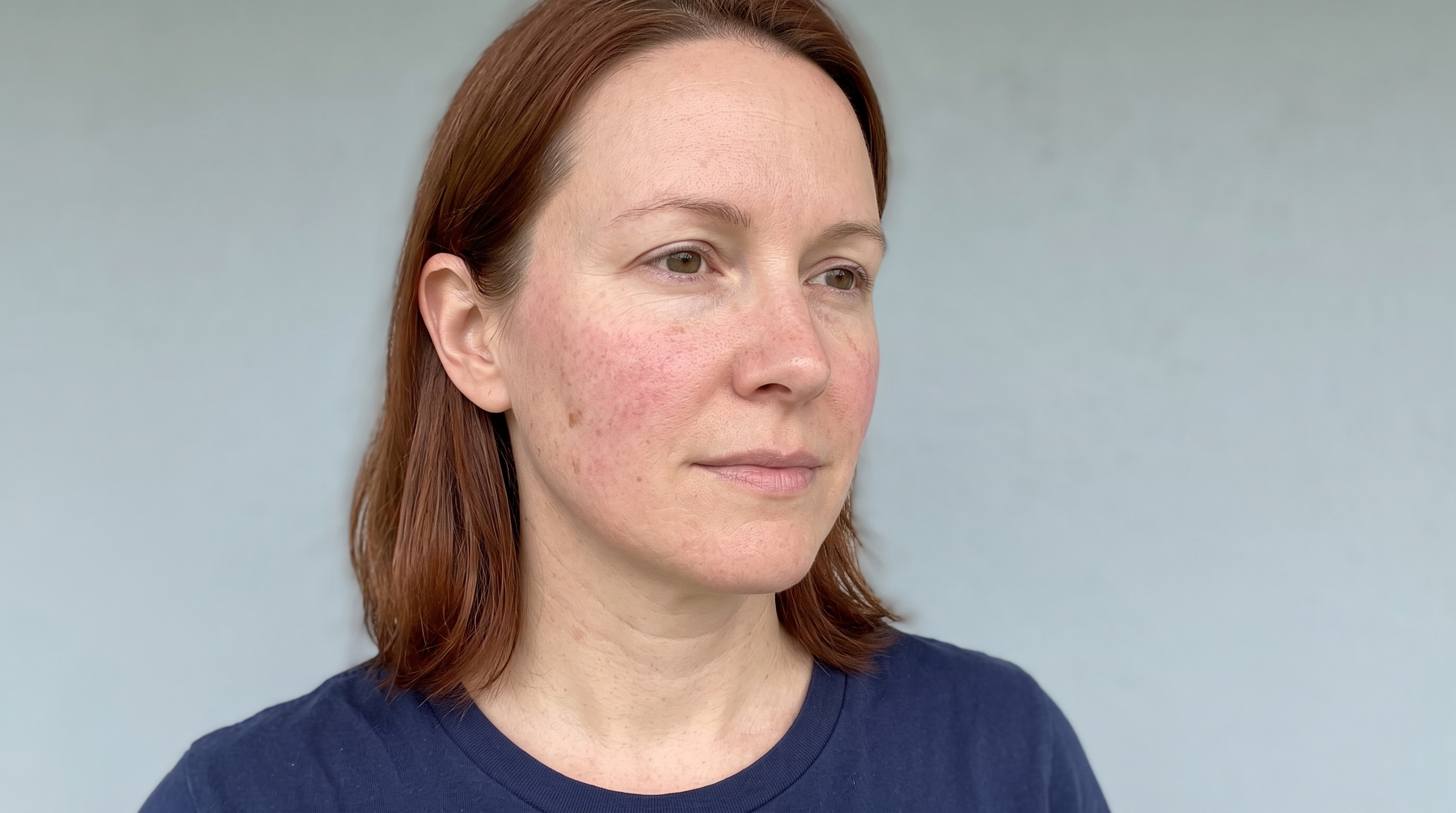 Azelaic Acid Toner: What It Can Do for Redness and Dark Marks, and What It Cannot