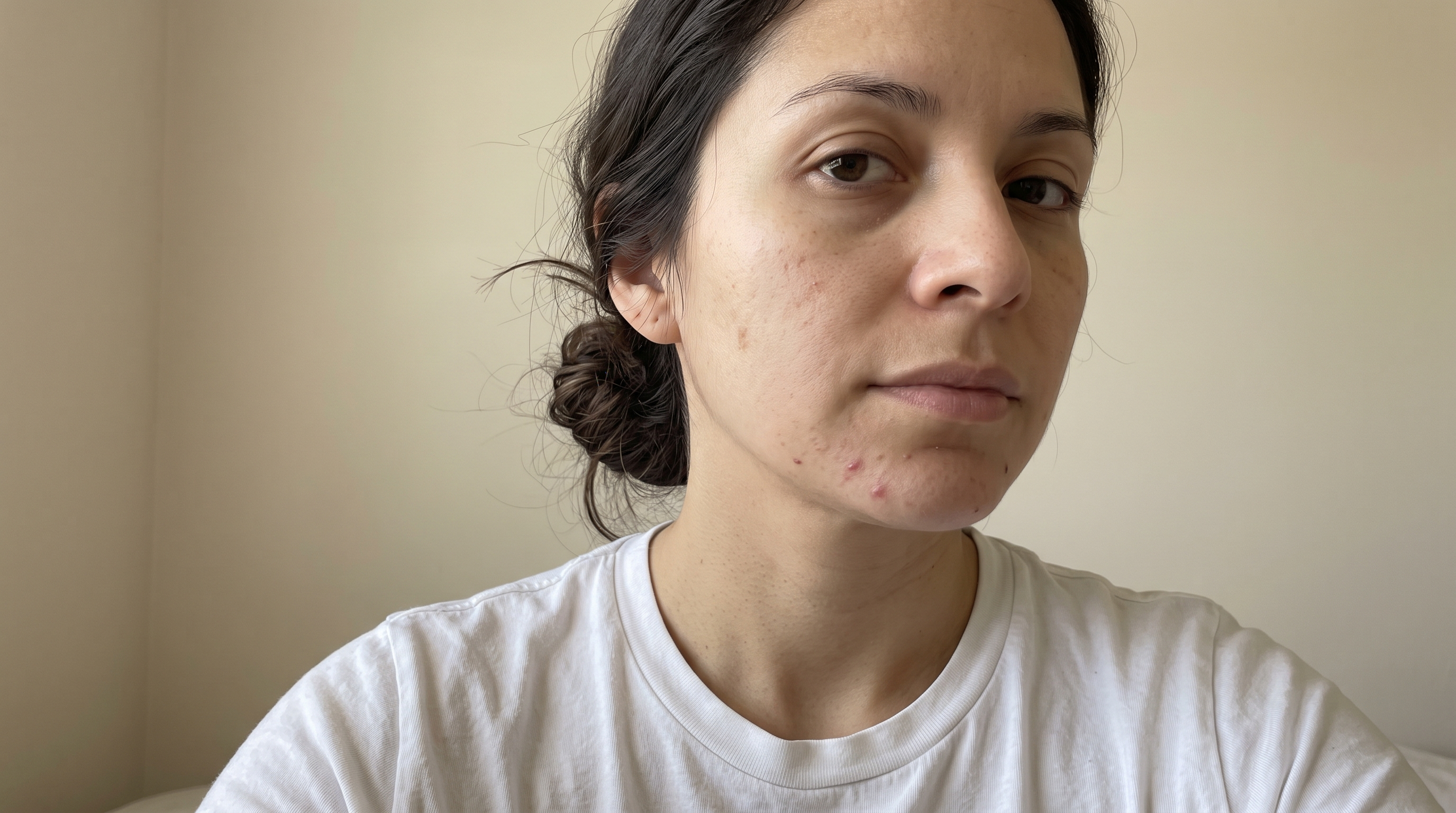 Benzoyl Peroxide Cream: Which Strength, Cream or Gel, and How to Use It With Retinol
