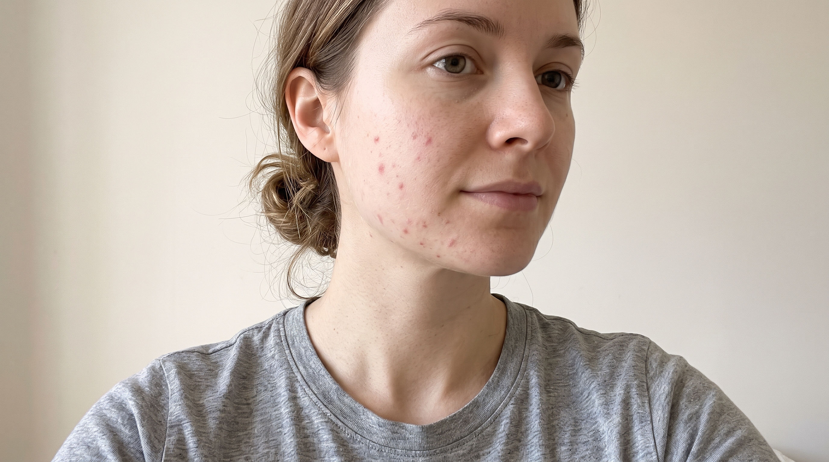 Post-Inflammatory Erythema: How to Fade Red Acne Marks