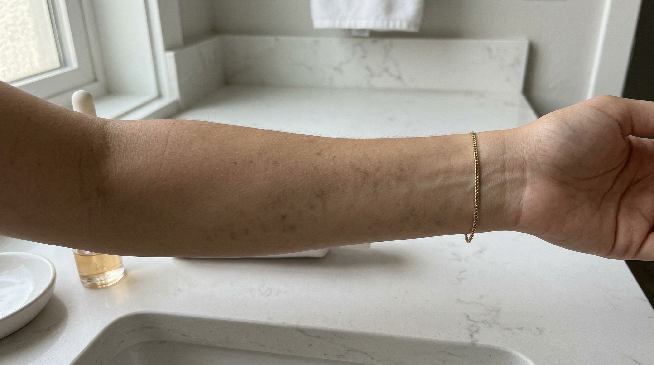 Post-Inflammatory Hyperpigmentation: Why Those Dark Spots Linger and How to Actually Fade Them