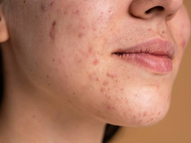 Retinol and Your Skin Barrier: How to Protect While You Transform