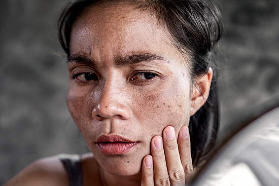 Can Retinol Reverse Sun Damage? What Science Says About Photoaging