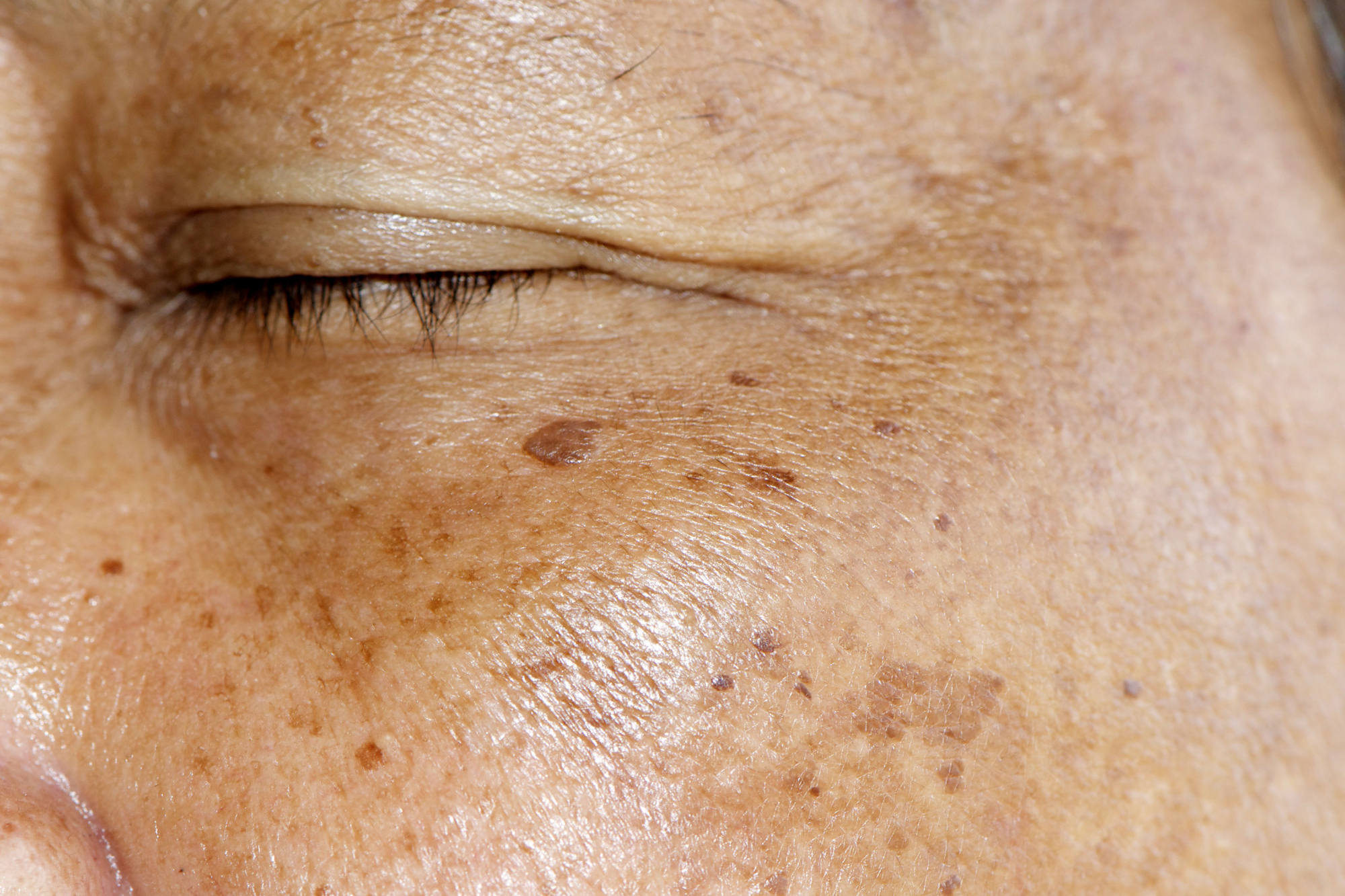 Tranexamic Acid for Dark Spots: A Gentler Approach to Hyperpigmentation